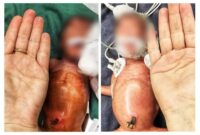 جراحی نجات بخش پارگی روده دوقلوهای نارس در بیمارستان کودکان بندرعباس جراحی نجات بخش پارگی روده دوقلوهای نارس در بیمارستان کودکان بندرعباس